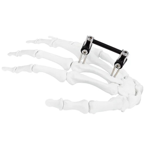 Mini Fragment External Fixator (Finger and Palm)