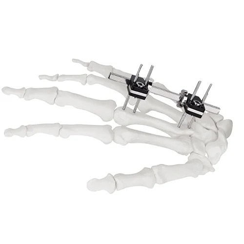 Mini Fragment External Fixator (Finger and Palm)