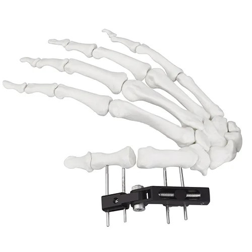 Mini Fragment External Fixator (Finger and Palm)