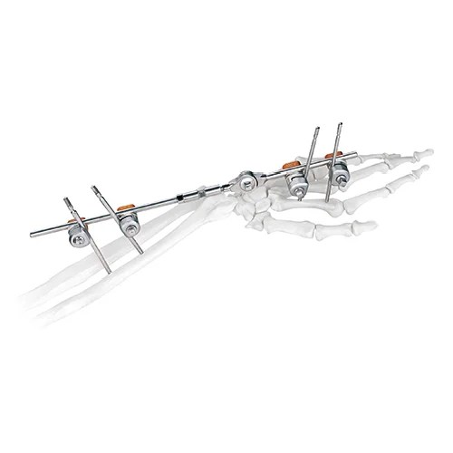 Wrist Joint External Fixator